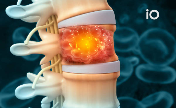 Symptoms and Treatment of Spinal Tumors: Don't Ignore Your Pain