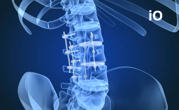 Screw Loosening and Rod Breakage After Instrumented Spine Surgery